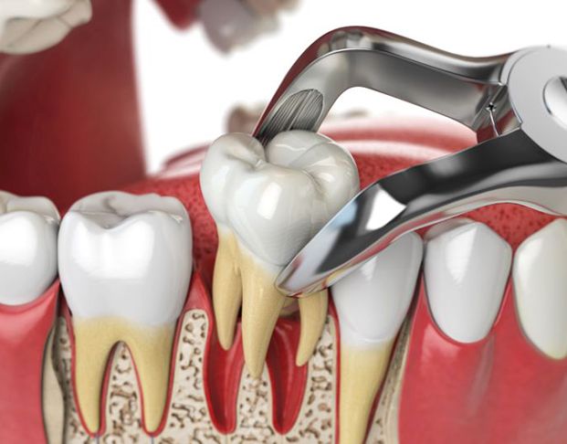 Illustration of forceps removing a tooth