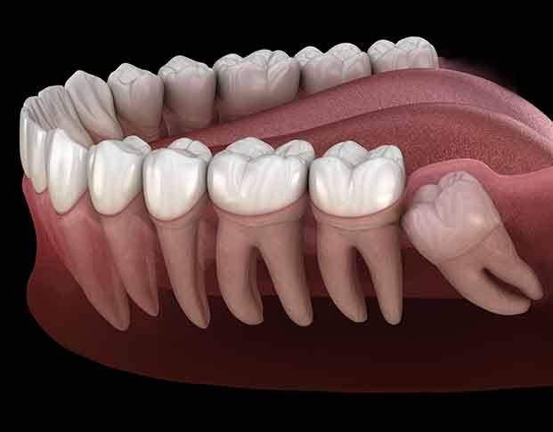 3D render of an impacted wisdom tooth